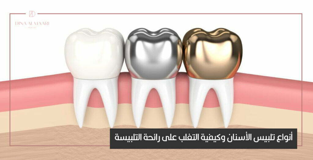 انواع تلبيس الأسنان