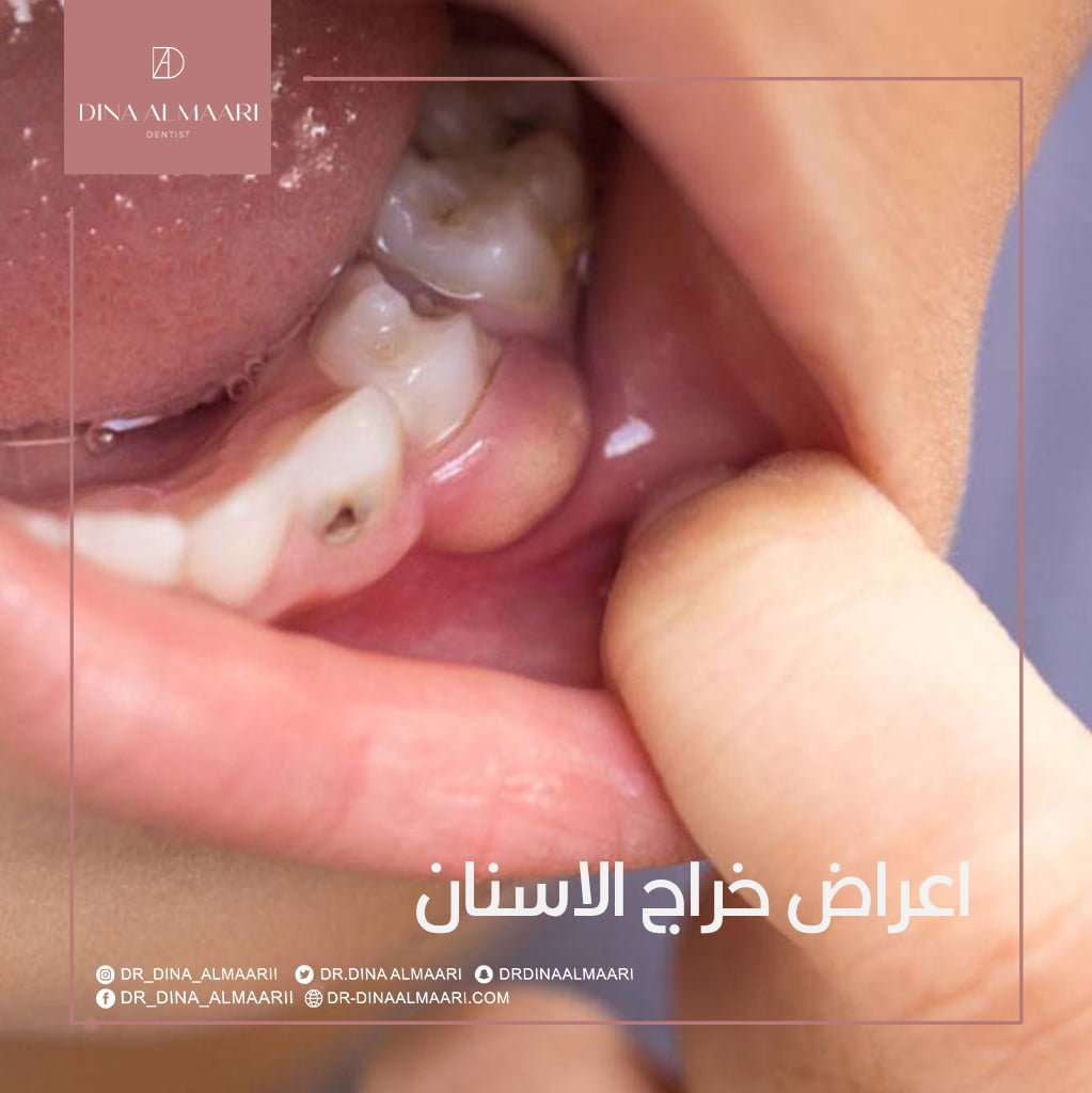 اعراض خراج الاسنان